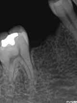 右下第2小臼歯の先天欠損1